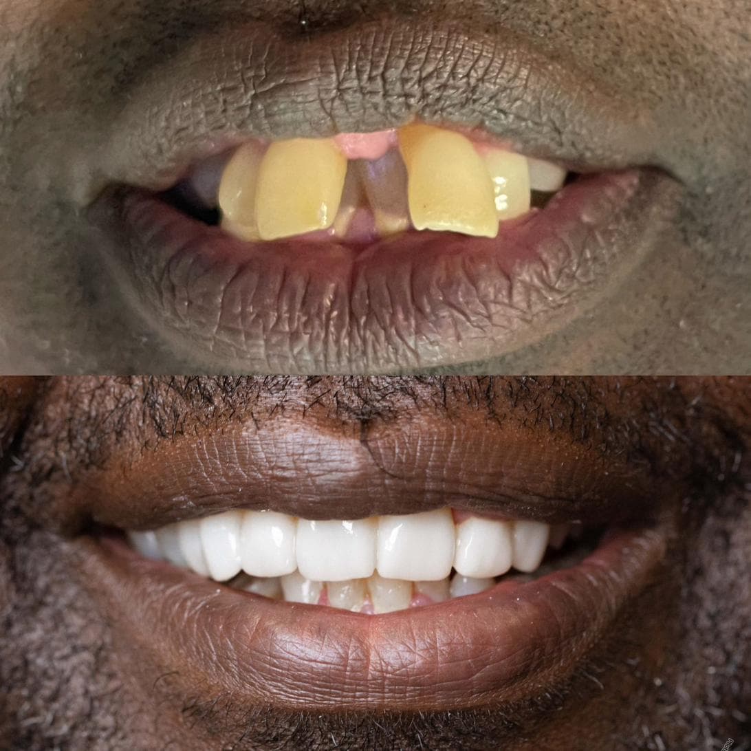 Completed smile restoration by The Smile Lab Africa